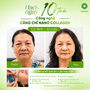 Grand Skin Care - Căng Chỉ Nano Collagen Trẻ 10 Tuổi - Hiệu Quả